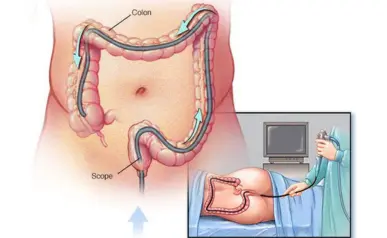 Colonoscopy Image